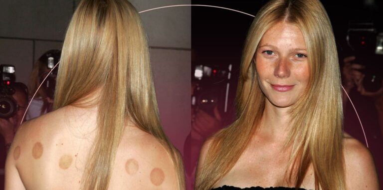 toxin pulling cupping hijama