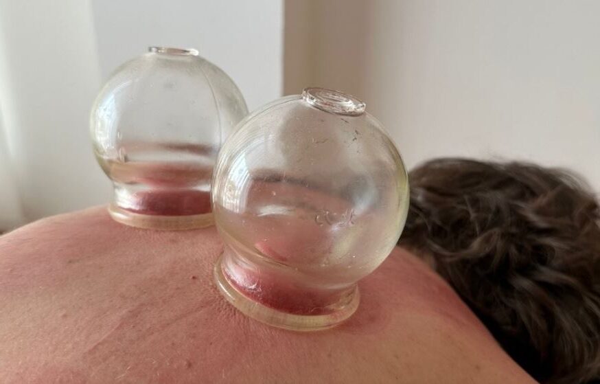 cupping therapy