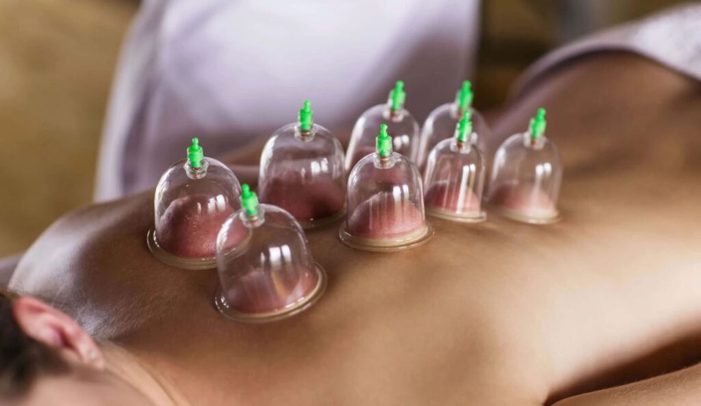 what is hijama therapy