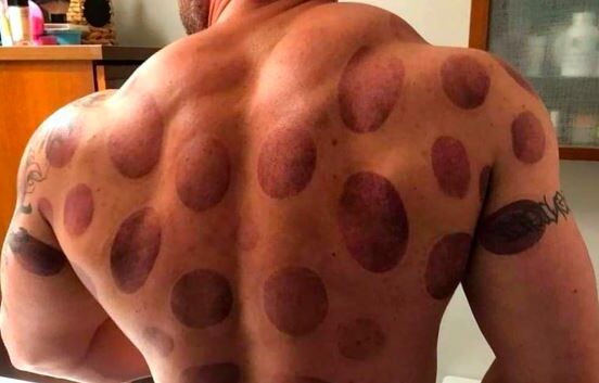 cupping marks explained