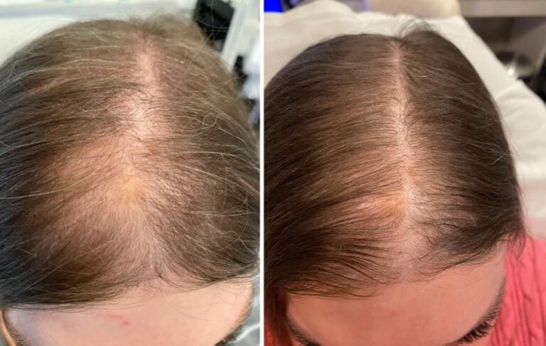 hydrafacial keravive scalp treatment
