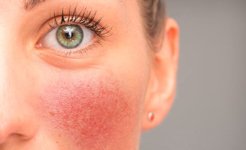 permanently get rid of rosacea