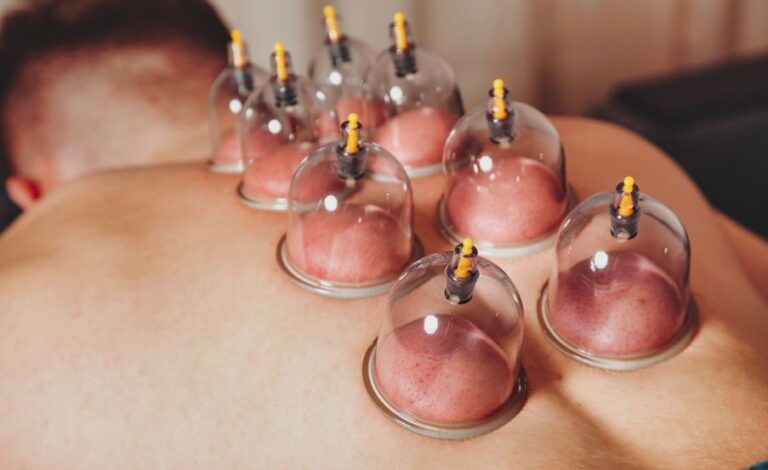 what toxins does cupping remove