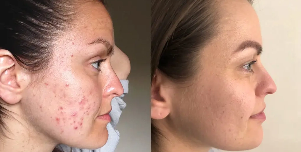 before and after getting an soul detox acne clearing facial in brooklyn ny