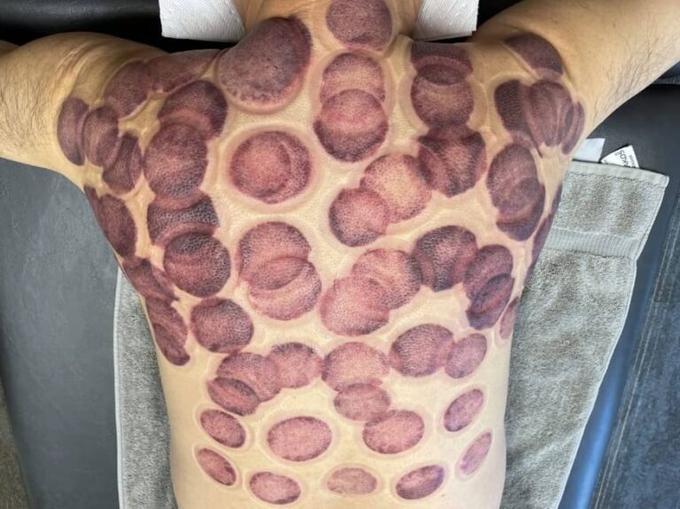 A person's back is covered in numerous dark reddish-purple circular cupping marks. This image visually represents the issue for readers looking to get rid of cupping marks fast.