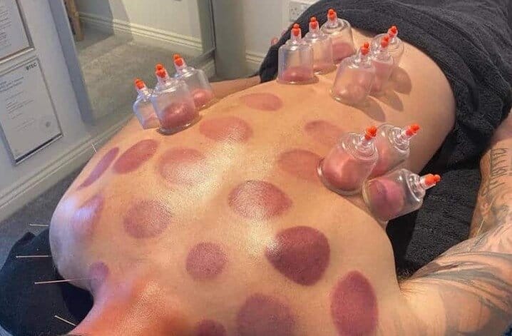 A close-up of a person's back showing cupping marks with some of the therapy cups still attached. This photo illustrates a common result that makes people search for how to get rid of cupping marks fast.