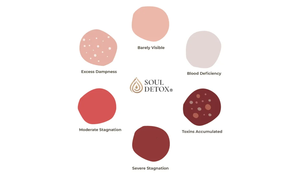 Cupping marks chart showing different bruise colors and their meanings in cupping therapy
