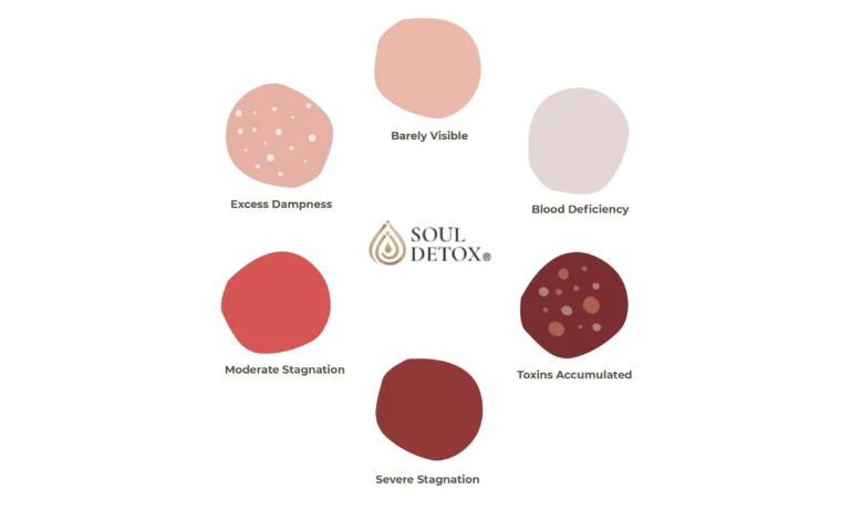 Cupping marks chart showing different bruise colors and their meanings in cupping therapy
